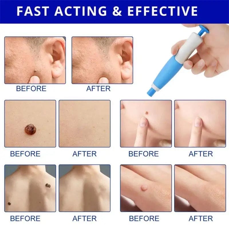 Skin Tag Remover, 2 In1 Painless Auto Skin Tag Remover, Mole Wart Removal Kit, Micro Skin Tag Remover Skin Tag Remover, 2 In1 Painless Auto Skin Tag Remover, Mole Wart Removal Kit, Micro Skin Tag Remover